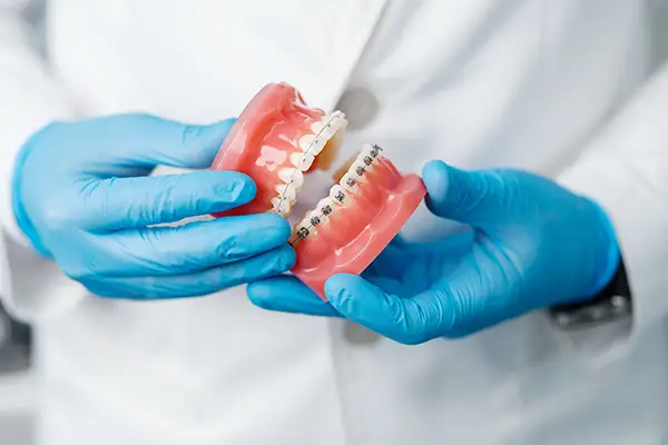 A dentist's gloved hand holding a dental model with metal braces to explain orthodontic treatment options. A dentist's gloved hand holding a dental model with metal braces to explain orthodontic treatment options.