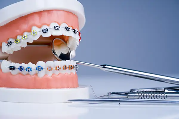 Orthodontic model and dentist tool demonstrating the varieties of orthodontic bracket or brace. Orthodontic model and dentist tool demonstrating the varieties of orthodontic bracket or brace.