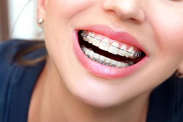 Closeup female smile with ceramic braces teeth. Orthodontic treatment. Closeup female smile with ceramic braces teeth. Orthodontic treatment.