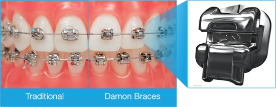 Comparison of traditional braces and Damon braces Comparison of traditional braces and Damon braces