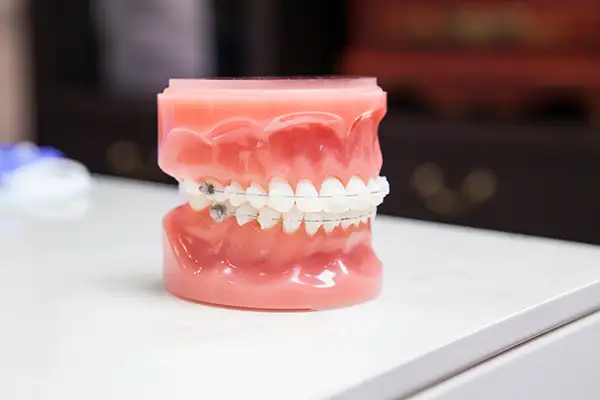A dental model featuring clear braces, displayed on a countertop in a clinic setting for orthodontic demonstration. A dental model featuring clear braces, displayed on a countertop in a clinic setting for orthodontic demonstration.