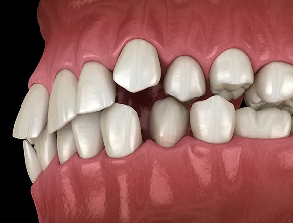 Side-view of computer generated teeth model, showing how crooked teeth overlap and interact with each other.