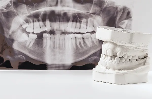 A plaster dental cast sitting next to a full x-ray of the jaw, both indicating the complications that arise from crooked and missing teeth. A plaster dental cast sitting next to a full x-ray of the jaw, both indicating the complications that arise from crooked and missing teeth.