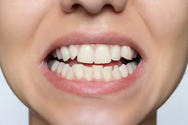Close up of someone grimacing to expose their mildly crooked teeth whose aesthetics could be improved by orthodontic treatment. Close up of someone grimacing to expose their mildly crooked teeth whose aesthetics could be improved by orthodontic treatment.