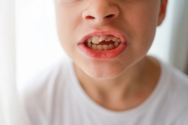 A close look at the crooked teeth (open bite) of a child that developed after thumb sucking, tongue thrusting, or a similar habit. A close look at the crooked teeth (open bite) of a child that developed after thumb sucking, tongue thrusting, or a similar habit.