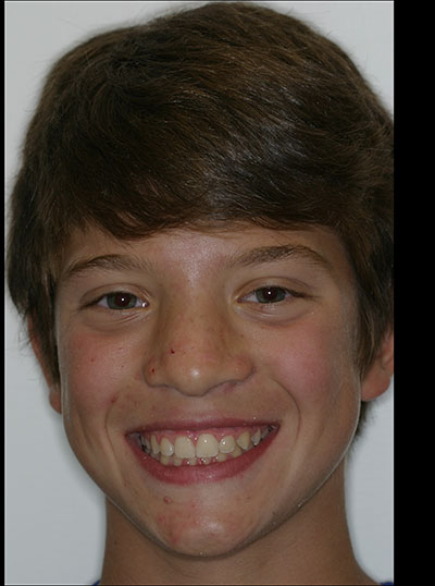 Results photo of patient after orthodontic treatment from Amborn Orthodontics in Salem