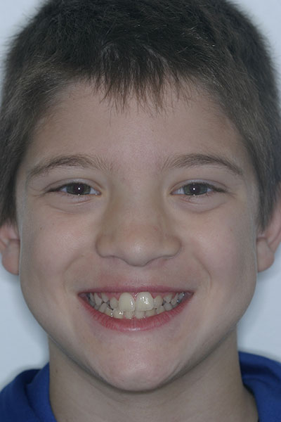Before photo of patient prior to orthodontic treatment from Amborn Orthodontics in Salem