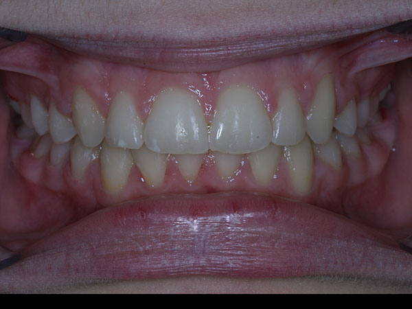 Results photo of patient after orthodontic treatment from Amborn Orthodontics in Salem