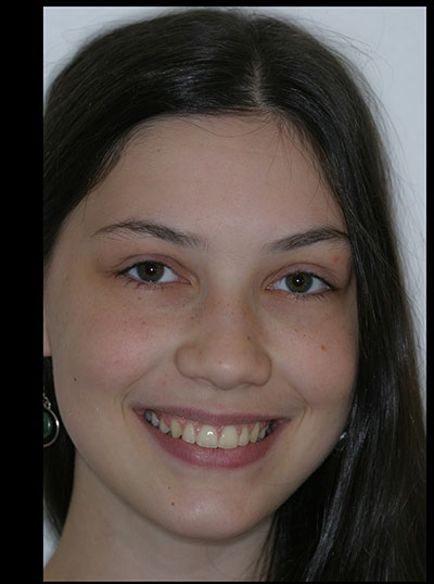 Results photo of patient after orthodontic treatment from Amborn Orthodontics in Salem