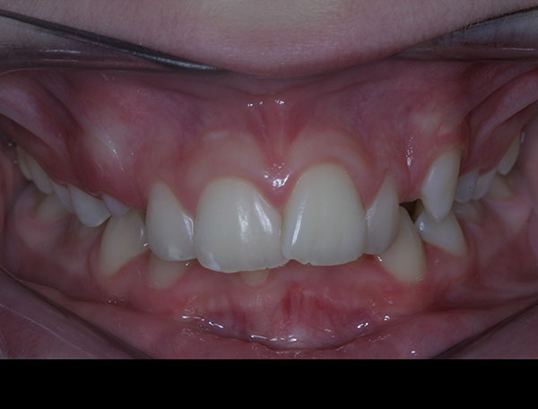 Before photo of patient prior to orthodontic treatment from Amborn Orthodontics in Salem