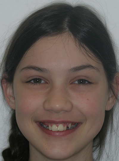 Before photo of patient prior to orthodontic treatment from Amborn Orthodontics in Salem