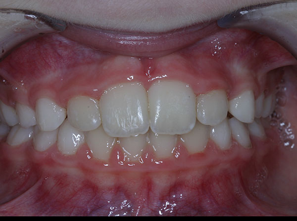 Results photo of patient after orthodontic treatment from Amborn Orthodontics in Salem