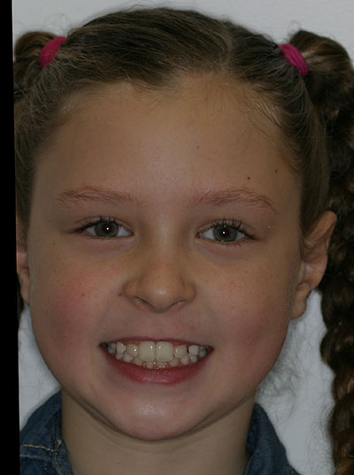 Results photo of patient after orthodontic treatment from Amborn Orthodontics in Salem