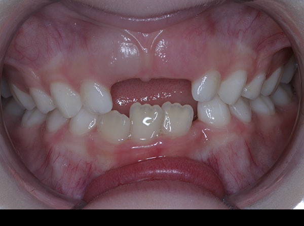 Before photo of patient prior to orthodontic treatment from Amborn Orthodontics in Salem