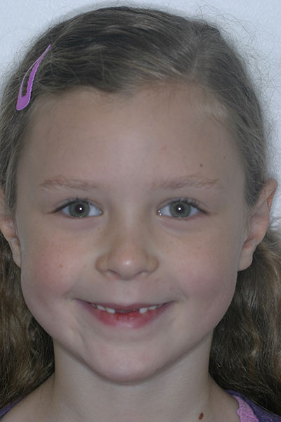 Before photo of patient prior to orthodontic treatment from Amborn Orthodontics in Salem