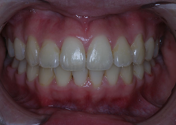 Results photo of patient after orthodontic treatment from Amborn Orthodontics in Salem