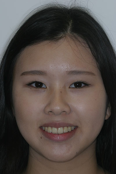 Results photo of patient after orthodontic treatment from Amborn Orthodontics in Salem