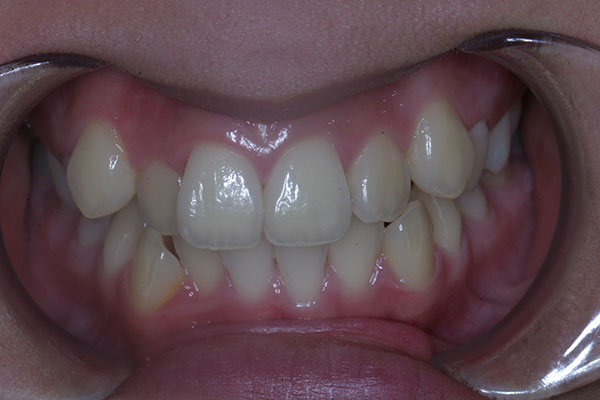 Before photo of patient prior to orthodontic treatment from Amborn Orthodontics in Salem
