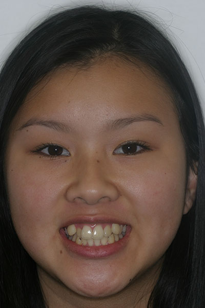 Before photo of patient prior to orthodontic treatment from Amborn Orthodontics in Salem
