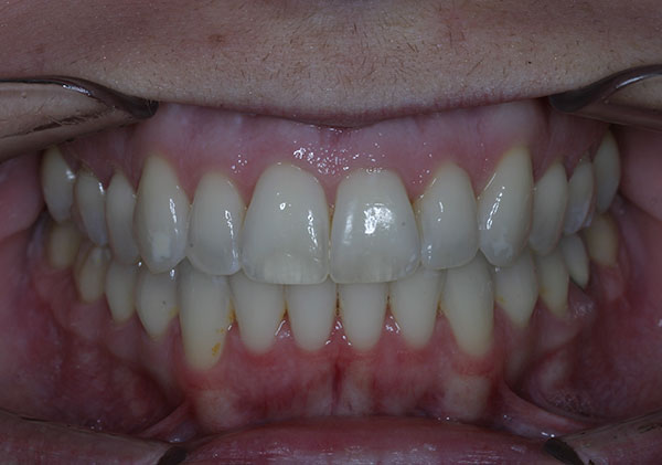 Results photo of patient after orthodontic treatment from Amborn Orthodontics in Salem