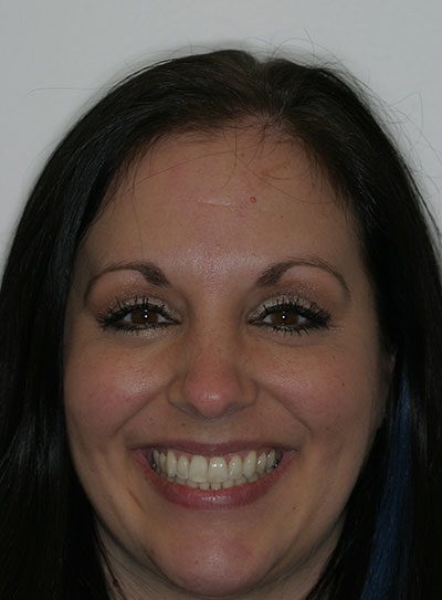 Results photo of patient after orthodontic treatment from Amborn Orthodontics in Salem