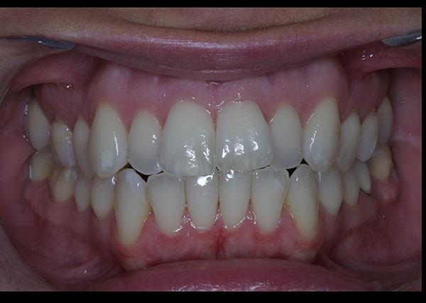 Before photo of patient prior to orthodontic treatment from Amborn Orthodontics in Salem