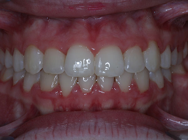 Results photo of patient after orthodontic treatment from Amborn Orthodontics in Salem