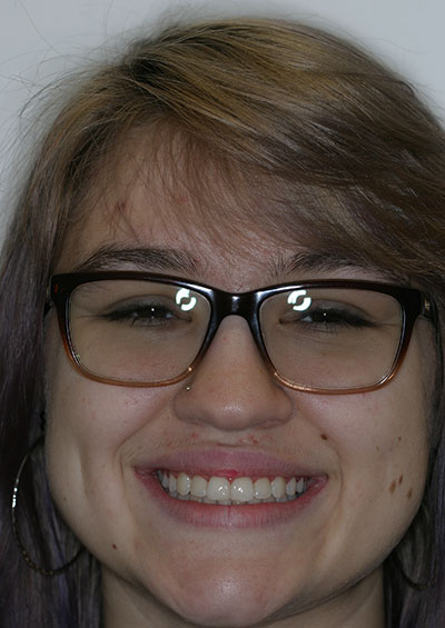 Results photo of patient after orthodontic treatment from Amborn Orthodontics in Salem