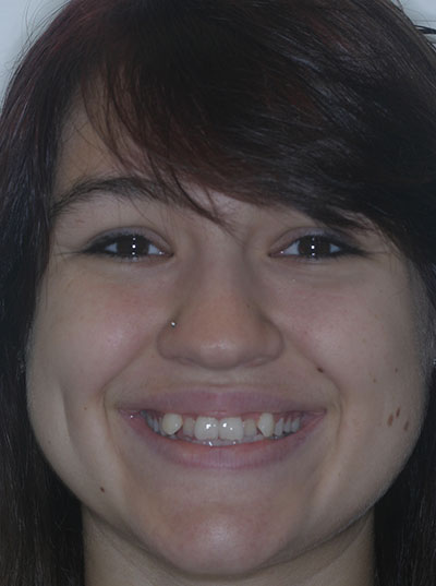 Before photo of patient prior to orthodontic treatment from Amborn Orthodontics in Salem