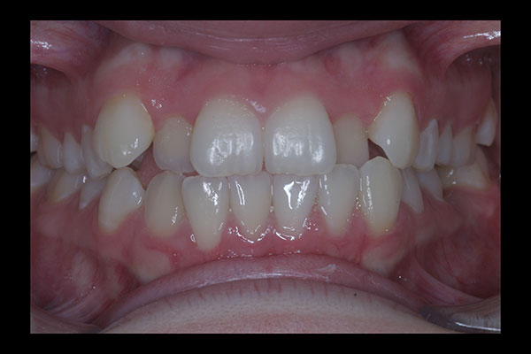 Before photo of patient prior to orthodontic treatment from Amborn Orthodontics in Salem