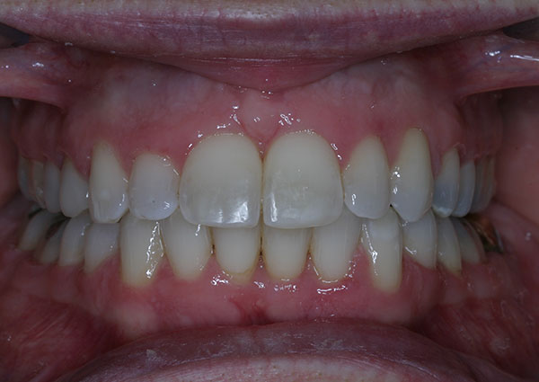 Results photo of patient after orthodontic treatment from Amborn Orthodontics in Salem