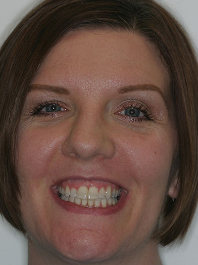 Results photo of patient after orthodontic treatment from Amborn Orthodontics in Salem