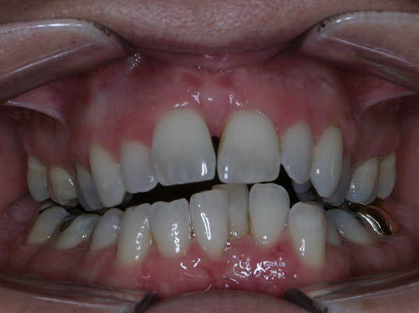 Before photo of patient prior to orthodontic treatment from Amborn Orthodontics in Salem