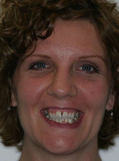 Before photo of patient prior to orthodontic treatment from Amborn Orthodontics in Salem