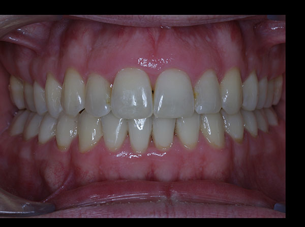 Results photo of patient after orthodontic treatment from Amborn Orthodontics in Salem
