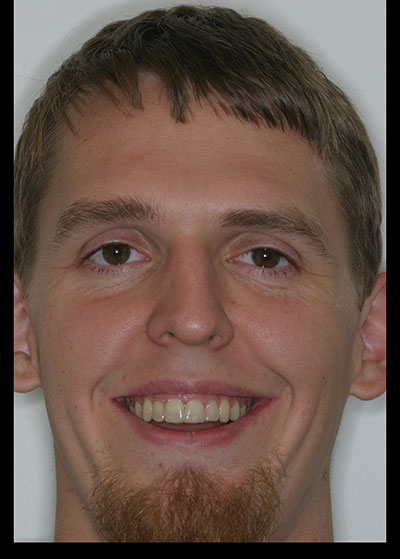 Results photo of patient after orthodontic treatment from Amborn Orthodontics in Salem