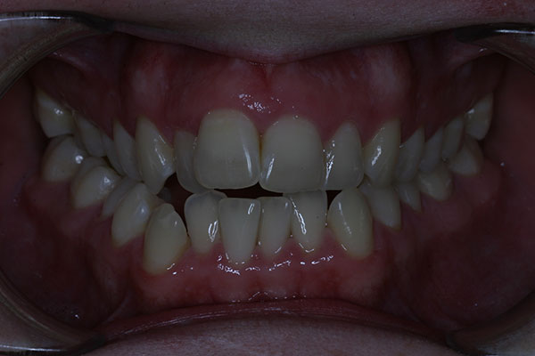 Before photo of patient prior to orthodontic treatment from Amborn Orthodontics in Salem