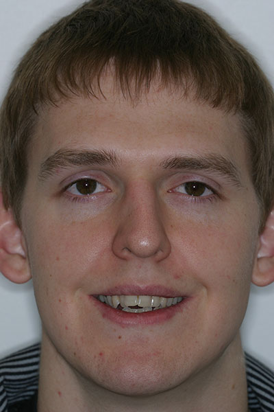 Before photo of patient prior to orthodontic treatment from Amborn Orthodontics in Salem